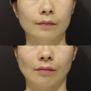 【ほうれい線ヒアルロン酸】中顔面サポートで自然な改善｜30代女性 【新宿】の症例写真