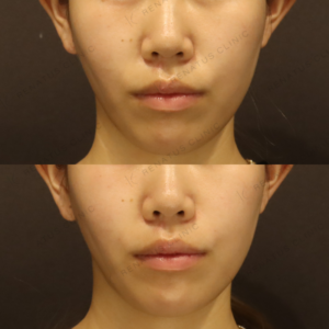 新宿でほうれい線ヒアルロン酸が上手い｜20代女性・ダイヤモンドフィール/ピネハ使用の症例写真