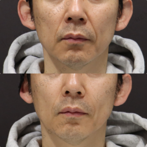 【ほうれい線ヒアルロン酸】中顔面の落ち込み補正｜40代男性【東京】の症例写真