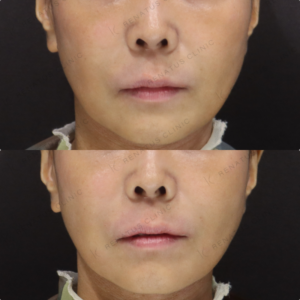 新宿のヒアルロン酸注射が上手いクリニック｜ボライトで40代女性のほうれい線を自然に改善の症例写真