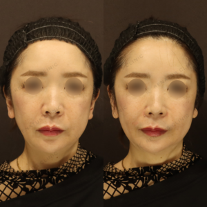 新宿のほうれい線ヒアルロン酸で上手い｜ボリューマで自然に若返り・50代女性の症例写真