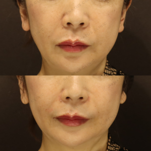 新宿のヒアルロン酸注射が上手い｜50代女性ほうれい線にボリフトで自然な若返りの症例写真