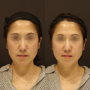 新宿でヒアルロン酸ほうれい線治療｜50代女性ボリフトの効果と料金の症例写真