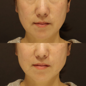 新宿でほうれい線ヒアルロン酸｜50代女性がボリフトで実感した効果と料金の症例写真