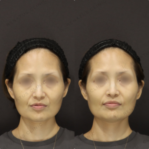 【ほうれい線ヒアルロン酸】溝を浅くし若見えに｜40代女性 ボリフト【東京】の症例写真