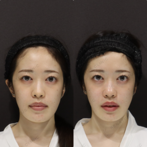 【ほうれい線ヒアルロン酸】柔らかい若見えライン｜20代女性 ボリフト【新宿】の症例写真