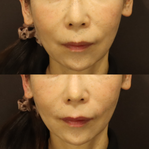 新宿でほうれい線ヒアルロン酸が上手い｜ボリフトで自然な若返り・50代女性の症例写真