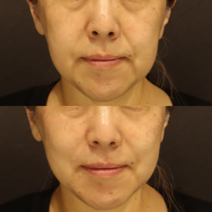 新宿のヒアルロン酸注射が上手い｜50代女性のゴルゴライン・ほうれい線をボルベラで自然に改善の症例写真