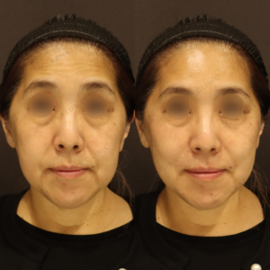 新宿のヒアルロン酸注射が上手い｜ボルベラでゴルゴライン・ほうれい線を改善した50代女性の症例写真