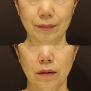 新宿のヒアルロン酸注射が上手いクリニック｜50代女性のほうれい線・口角にボルベラを使用の症例写真