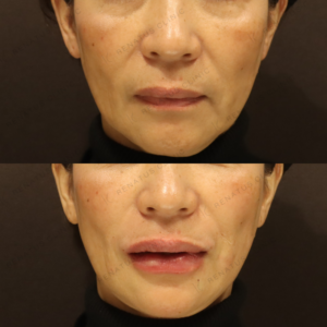 新宿のヒアルロン酸注射が上手い｜ボルベラで50代女性のほうれい線・唇を自然に若返りの症例写真