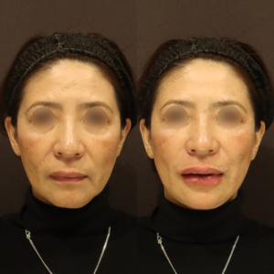 新宿のヒアルロン酸注射が上手い｜50代女性のほうれい線・唇にボルベラ使用の症例写真