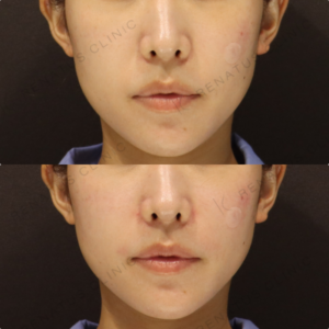 【鼻翼基部ヒアルロン酸】鼻柱角を整えて横顔改善｜30代女性 ボリューマ【代々木】の症例写真