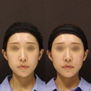 【鼻翼基部ヒアルロン酸】鼻柱角を整えて横顔改善｜30代女性 ボリューマ【代々木】の症例写真