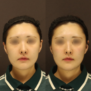 新宿のゴルゴラインヒアルロン酸注射が上手い｜ボリューマで自然に若返り・20代女性の症例写真