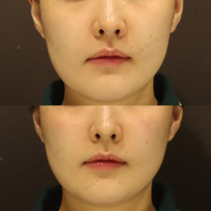 新宿のゴルゴラインヒアルロン酸注射が上手い｜ボリューマで自然に改善した20代女性の記録の症例写真