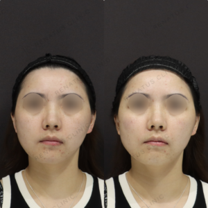 【ゴルゴラインヒアルロン酸】影を浅くして若見え｜30代女性 ボリューマ【新宿】の症例写真