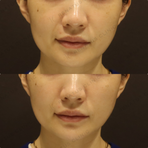 新宿のヒアルロン酸注射が上手いクリニック｜40代女性のゴルゴライン・顎をボリューマで自然に改善の症例写真