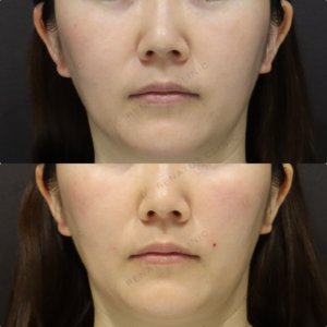 【ゴルゴラインヒアルロン酸】凹みを補正し立体感UP｜40代女性 ボリューマ【東京】の症例写真