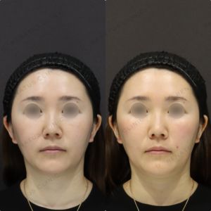 【ゴルゴラインヒアルロン酸】凹みを補正し立体感UP｜40代女性 ボリューマ【東京】の症例写真