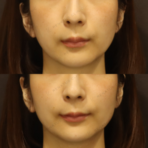 新宿のヒアルロン酸リフトアップで上手い｜ボラックス使用・30代女性の施術記録の症例写真