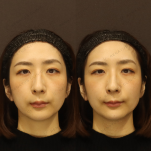 新宿のヒアルロン酸リフトアップが上手いクリニック｜ボラックスで叶える30代女性の自然な小顔の症例写真