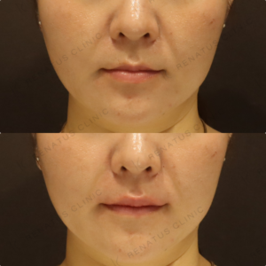 新宿の唇ヒアルロン酸で上手い｜ボルベラで自然に整えた30代女性の記録の症例写真