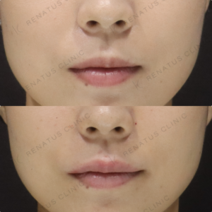 新宿の唇ヒアルロン酸注射が上手い｜ボルベラで自然な厚みを叶えた30代女性の記録の症例写真