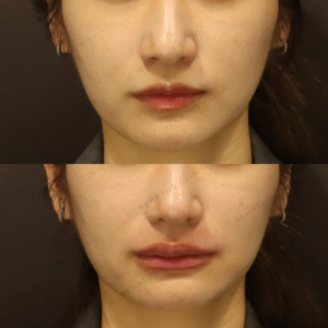 新宿の唇ヒアルロン酸注射が上手いクリニック｜30代女性・ボルベラで自然な厚みにの症例写真