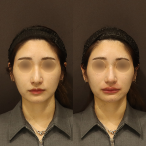 新宿の唇ヒアルロン酸注入が上手い｜ボルベラで自然な唇に整えた30代女性の施術記録の症例写真