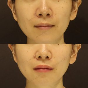 新宿の唇ヒアルロン酸注射が上手い｜ボルベラで自然な厚みを叶えた30代女性の症例写真