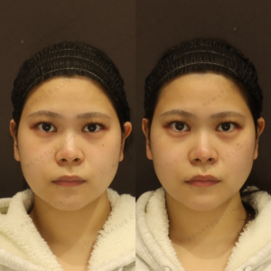 新宿の涙袋ヒアルロン酸注射が上手いと評判｜ボルベラで自然に盛る20代女性の施術の症例写真