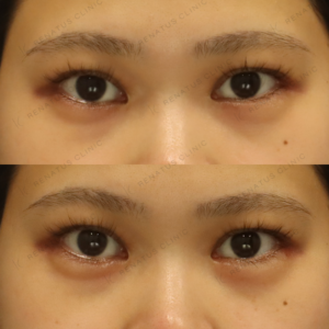 新宿の涙袋ヒアルロン酸で上手い｜ボルベラ使用・20代女性の自然な仕上がりの症例写真