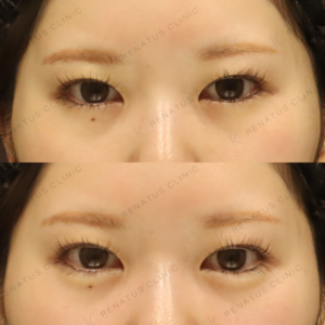 新宿の涙袋ヒアルロン酸で上手い｜ボルベラで自然な膨らみを叶えた20代女性の症例写真