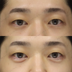 新宿の涙袋ヒアルロン酸で上手い｜ボルベラ使用・20代男性の自然な仕上がりの症例写真