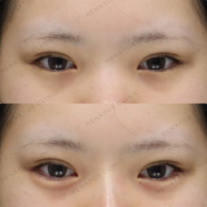 新宿の涙袋ヒアルロン酸で上手い｜ボルベラで自然に仕上げた10代女性の症例写真