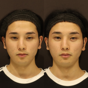 新宿の涙袋ヒアルロン酸で上手い｜ボルベラ使用・20代男性の自然な仕上がりの症例写真