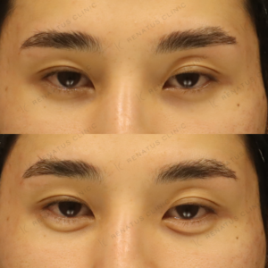 新宿の涙袋ヒアルロン酸で上手いクリニック｜ボルベラ使用・20代女性の自然な仕上がりの症例写真