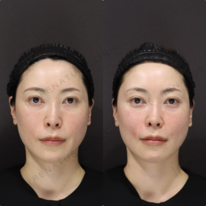 【カスタマイズヒアルロン酸】涙袋・ほうれい線のトータル改善｜30代女性【新宿】の症例写真