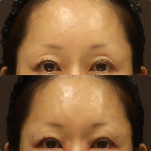 【目の上ヒアルロン酸】影の改善で柔らかい目元に｜ 40代女性 ボルベラ【新宿】の症例写真