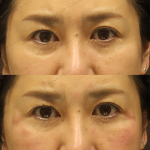 新宿で目の下ヒアルロン酸が上手い｜ボルベラで50代女性の眼窩縁を自然に若返りの症例写真