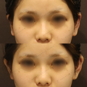 新宿で立ち耳ヒアルロン酸（ボルベラ）10代女性におすすめの効果・料金相場の症例写真