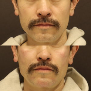 新宿のヒアルロン酸注射が上手い｜ボライトで頬を自然に整えた40代男性の記録の症例写真