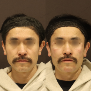 新宿で上手いヒアルロン酸注射｜ボライトで40代男性の頬をふっくら自然にの症例写真