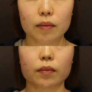 新宿のヒアルロン酸注射が上手い｜30代女性・頬・顎にボリフト使用の症例写真