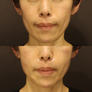 新宿のヒアルロン酸注射（頬）が上手いと評判｜40代女性・ピネハ使用例の症例写真