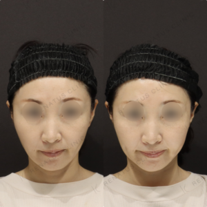 【頬ヒアルロン酸】頬の位置を上げて自然にリフト｜40代女性 【渋谷区】の症例写真