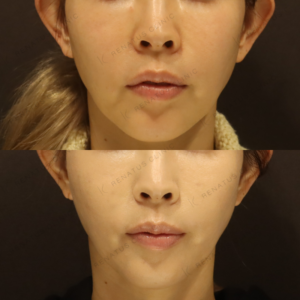新宿でヒアルロン酸（ボライト）頬のハリ改善｜40代女性におすすめの効果と料金の症例写真