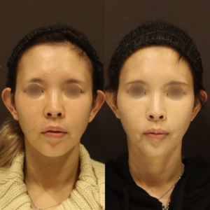 新宿で頬のヒアルロン酸（ボライト）40代女性におすすめの効果と料金相場の症例写真