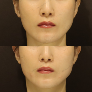 新宿ヒアルロン酸で頬のボリュームアップ｜30代女性がボリフトで自然な若返りを実現の症例写真